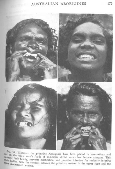 Unhealthy Aboriginies Poor Teeth and Tooth Decay