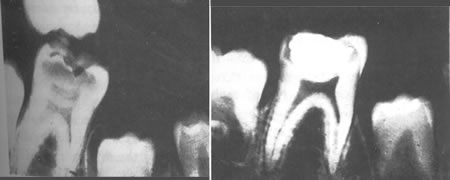 Before and After Cavity in Tooth Healing